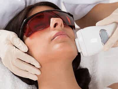 Hair Bleaching with Q Switch Laser