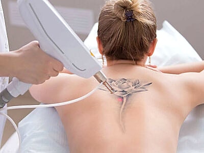 Q Switch Laser Tattoo Removal